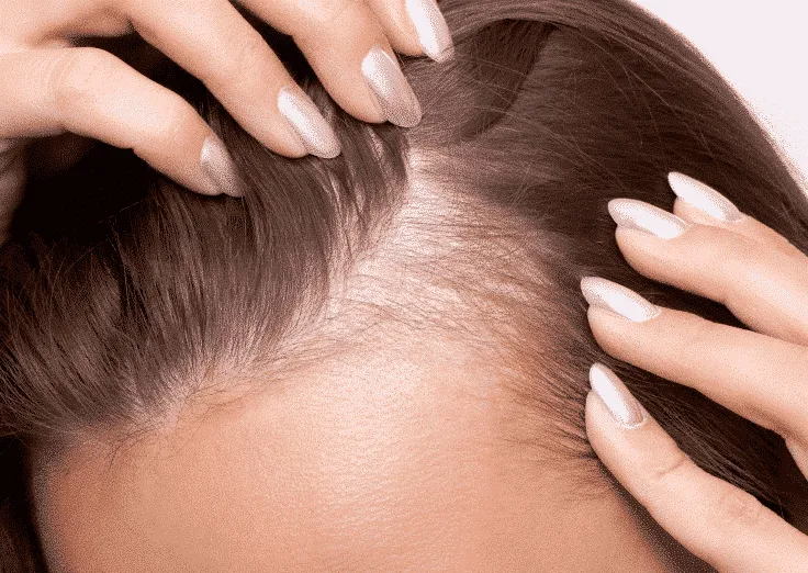 Early stage hair loss