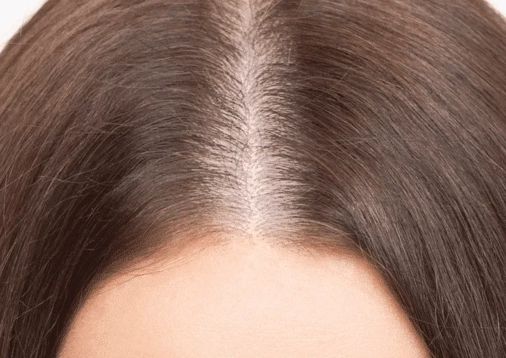 Female pattern hair loss