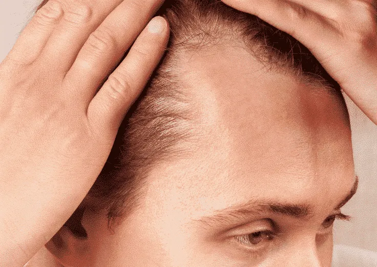 Male pattern baldness