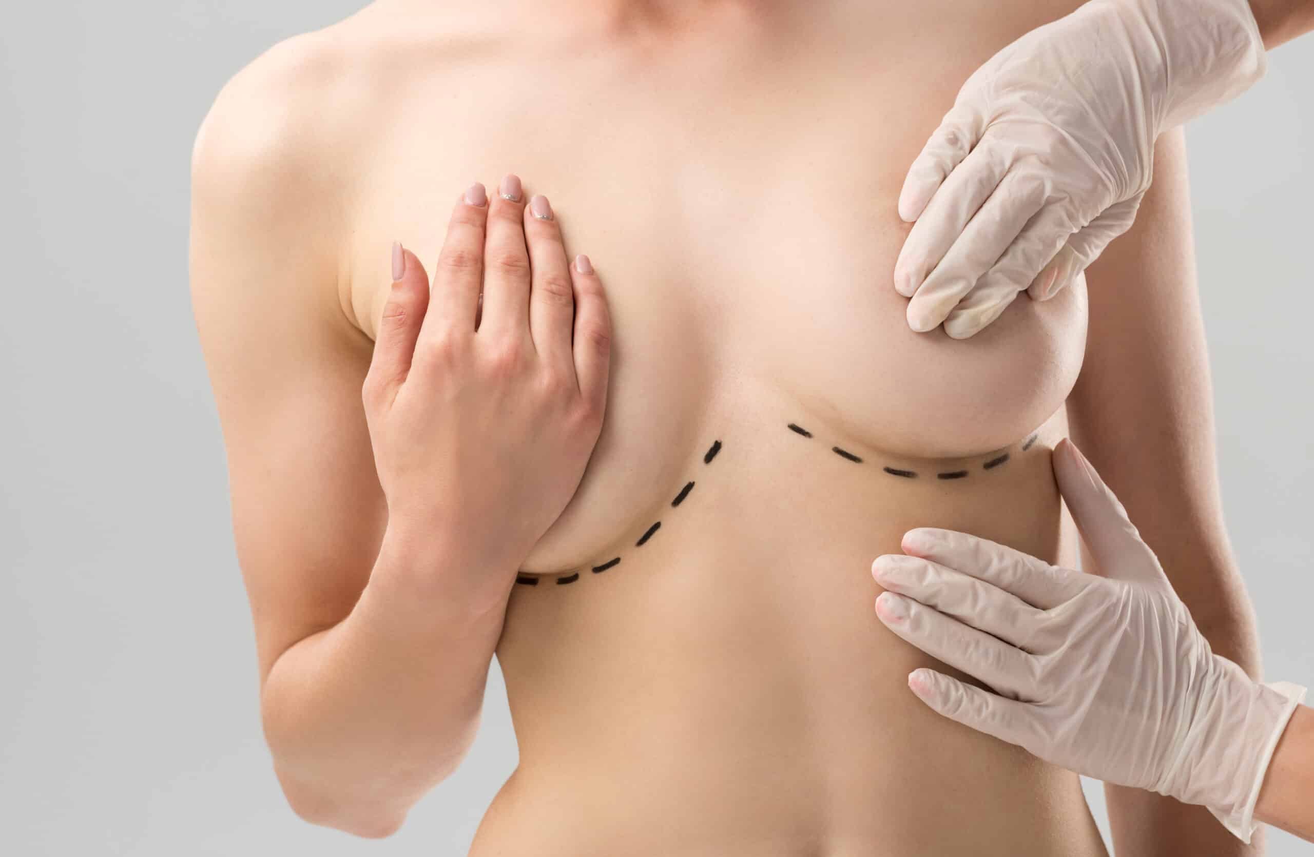 Breast Augmentation
