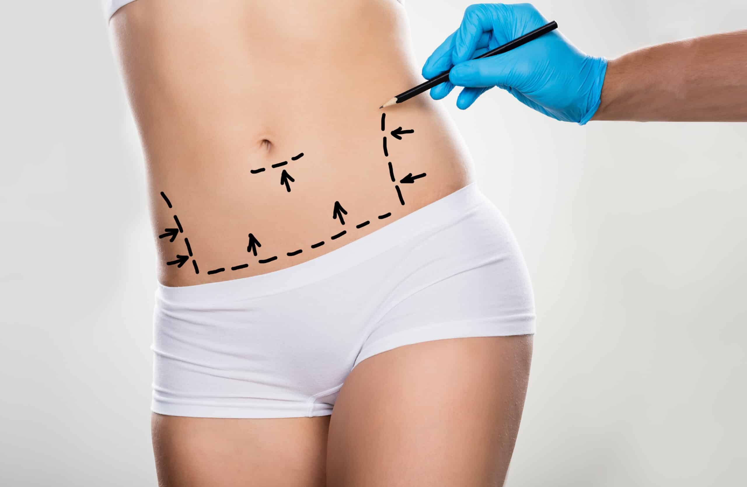 Tummy Tuck Abdominoplasty