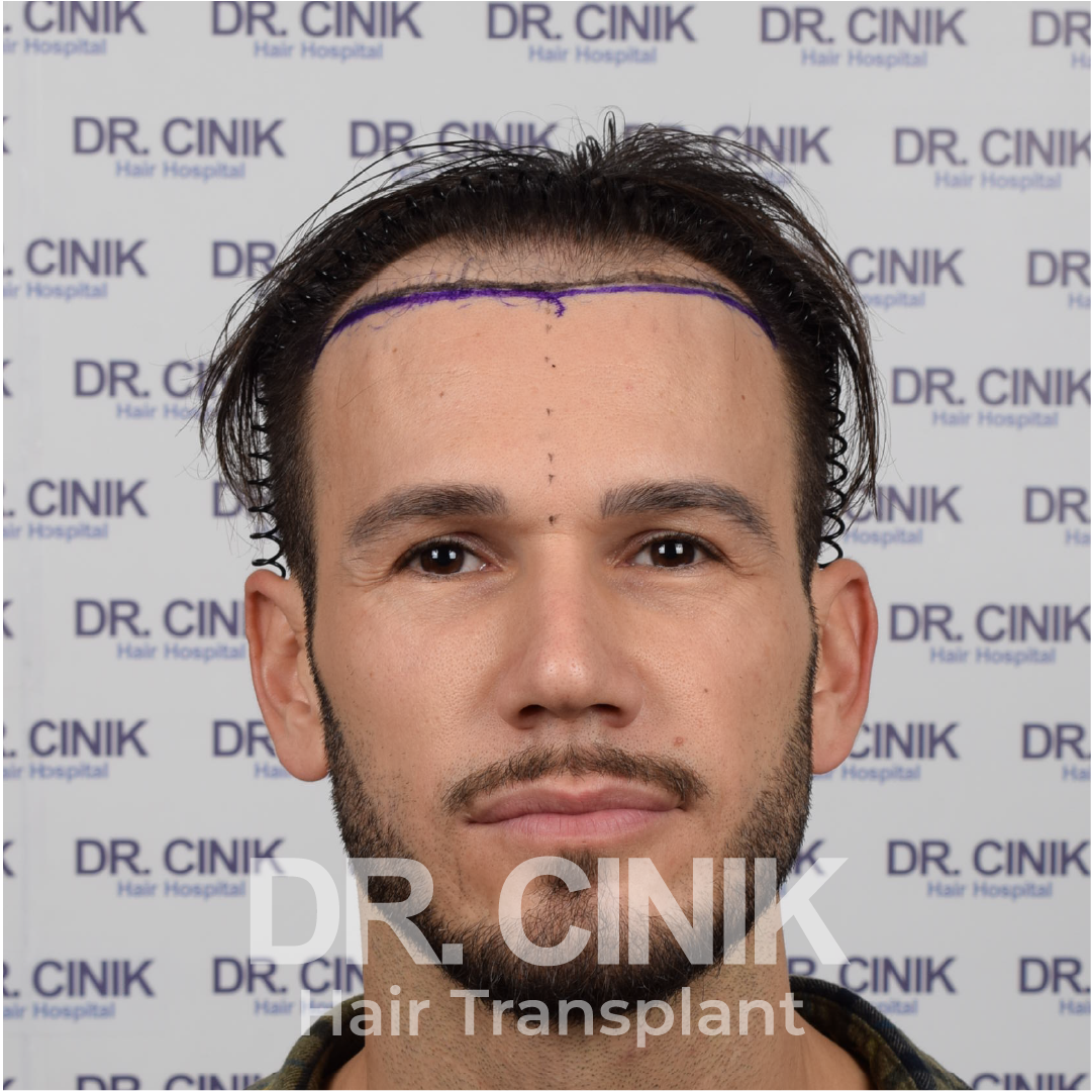 Before – Hair Transplant