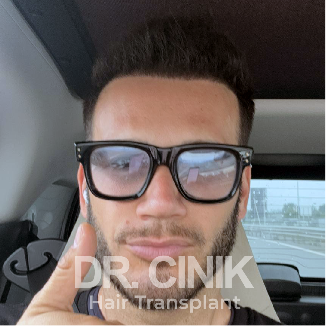 After – Hair Transplant