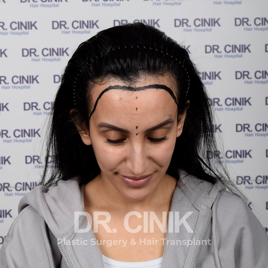 Before – Hair Transplant