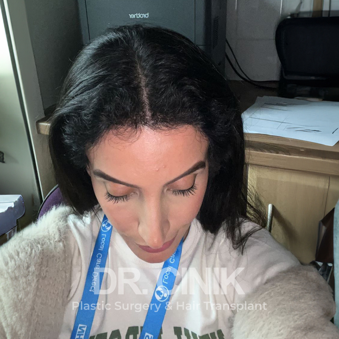 After – Hair Transplant