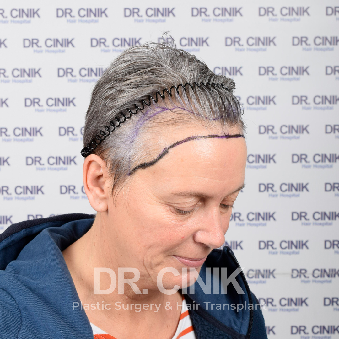 Before – Hair Transplant