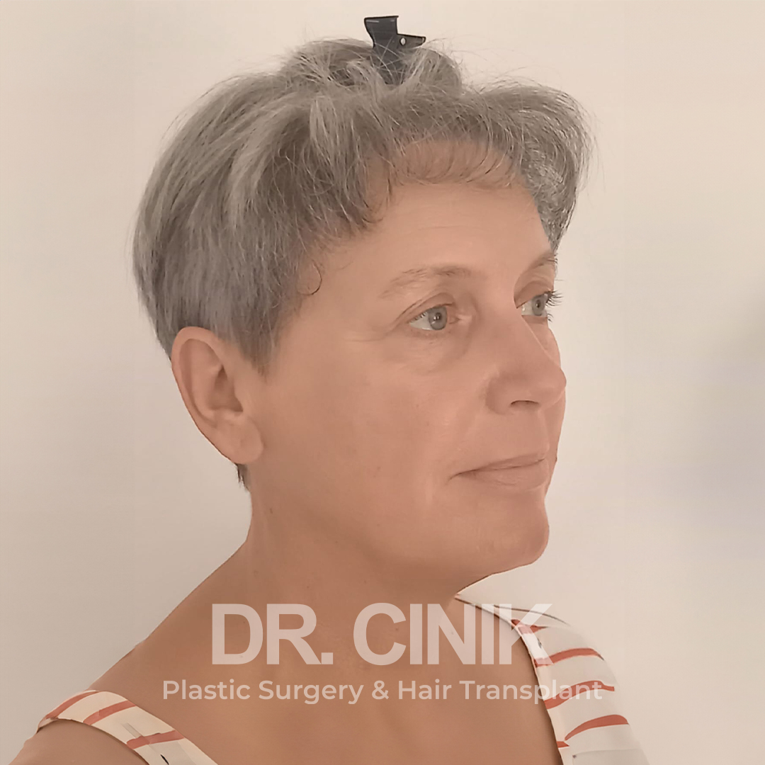 After – Hair Transplant