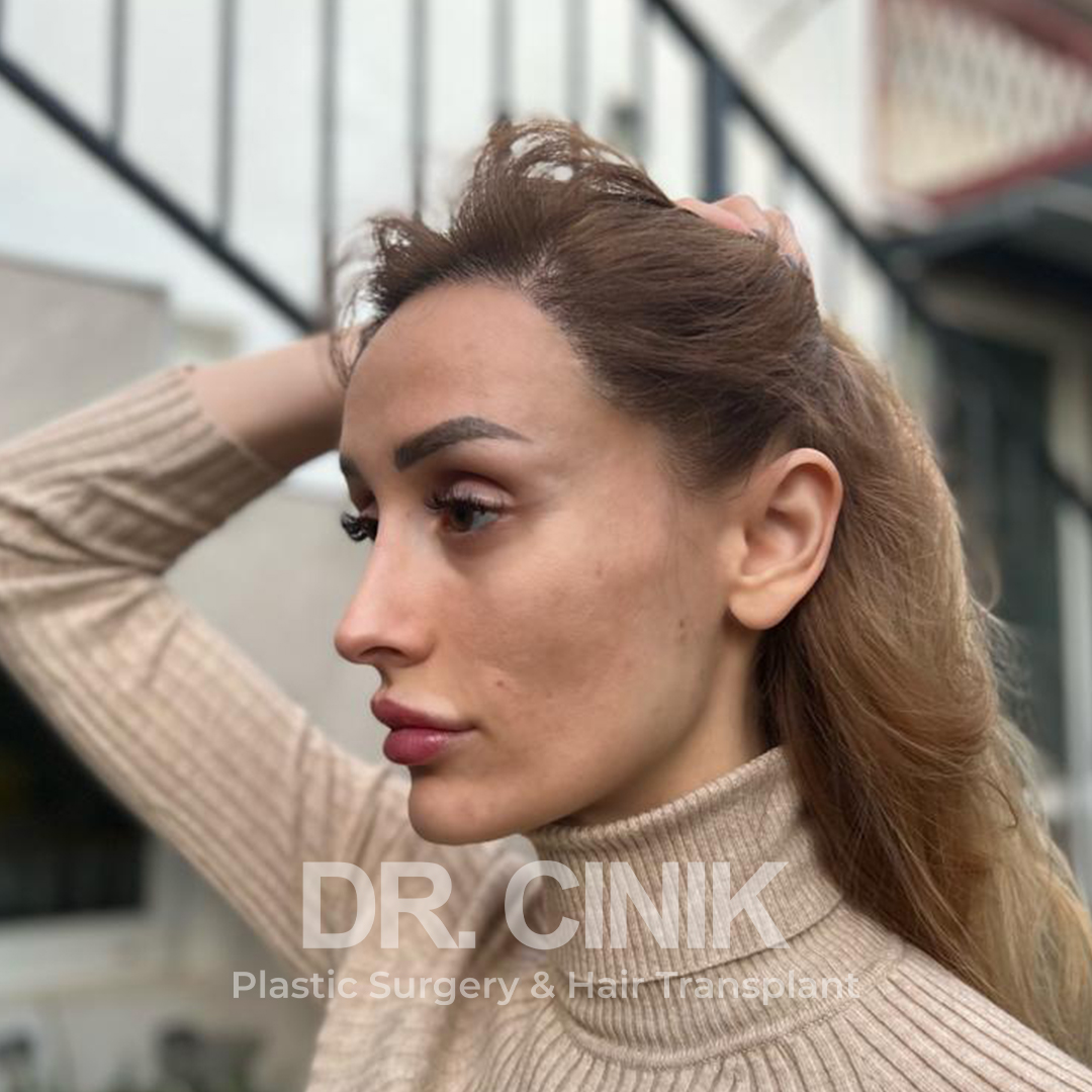 After – Hair Transplant