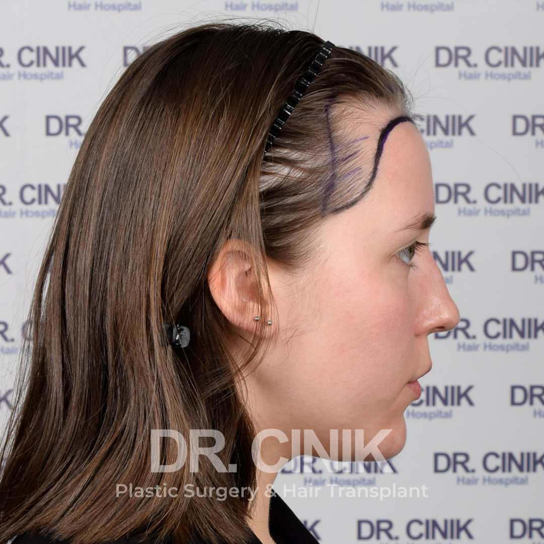 Before – Hair Transplant
