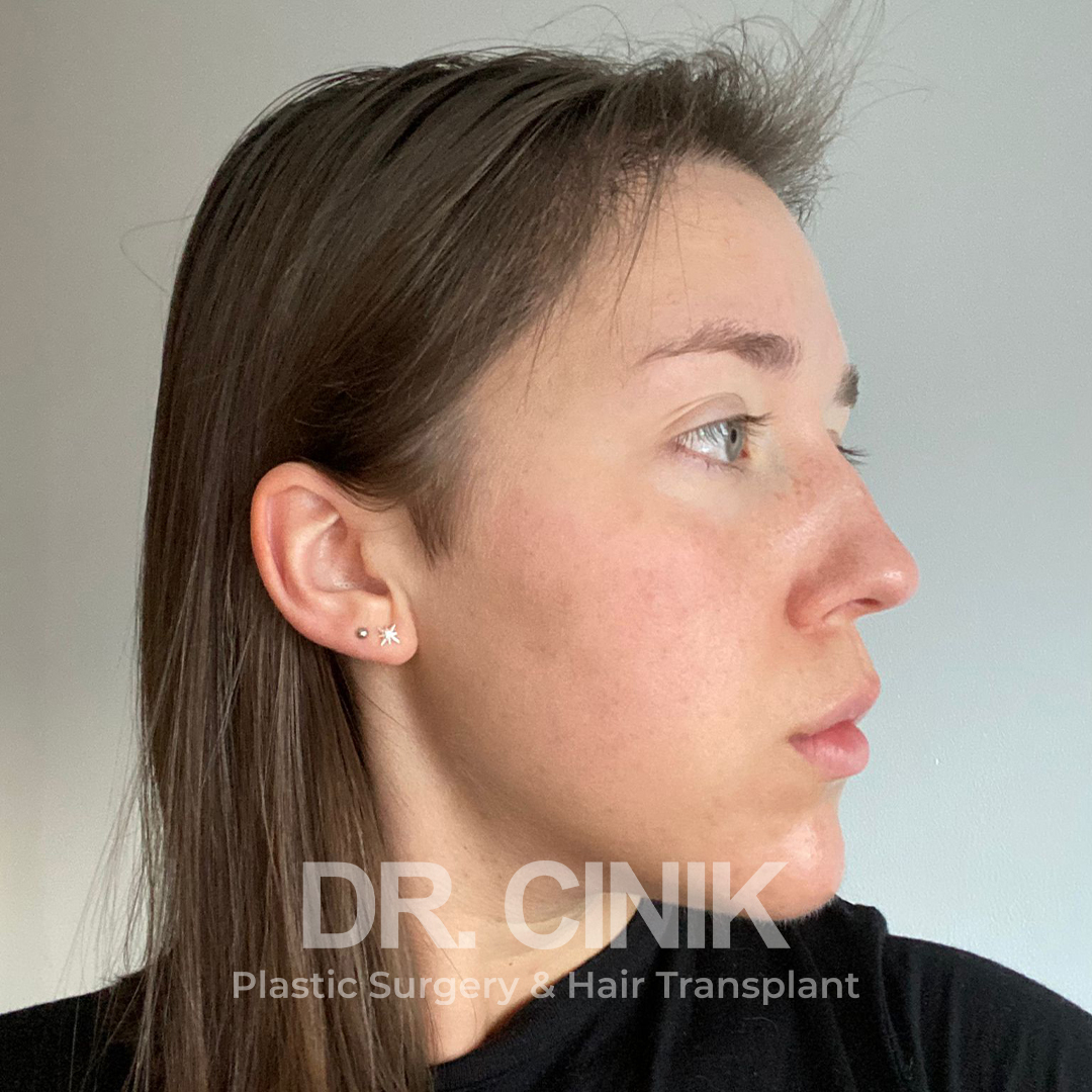 After – Hair Transplant